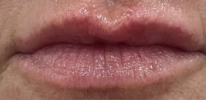 Lip Augmentation with Kysse