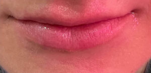 Lip Augmentation with Kysse